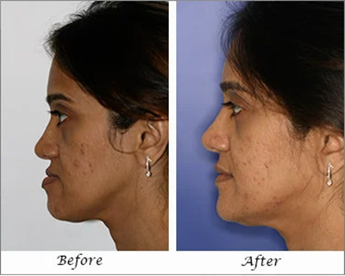 Jaw reconstruction surgery in Mumbai