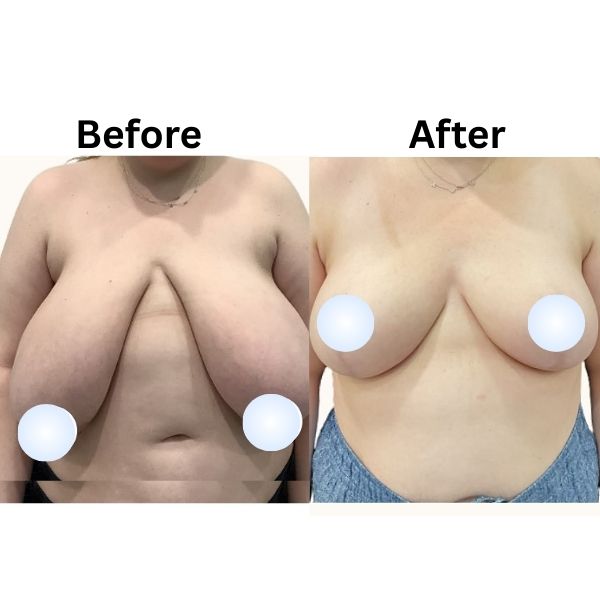 Breast reduction in Mumbai by Vinay Jacob