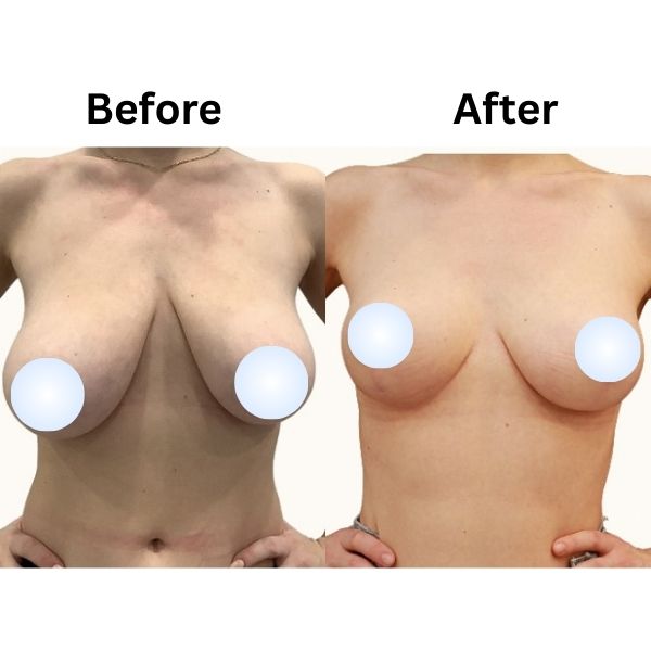 Breast reduction Before after result in Mumbai By Dr, Vinay Jacob