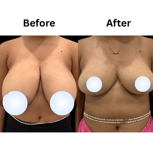 Before after Breast Reduction result by Dr. Vinay Jacob