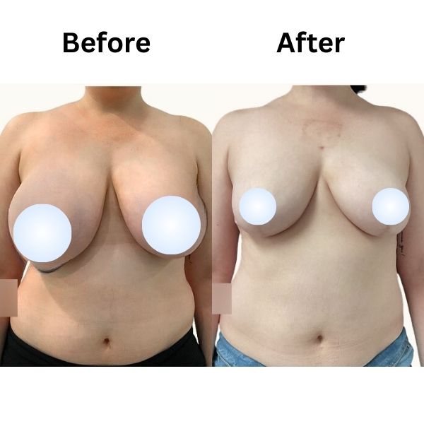 Before after Breast Reduction Result In Mumbai By Dr Vinay Jacob