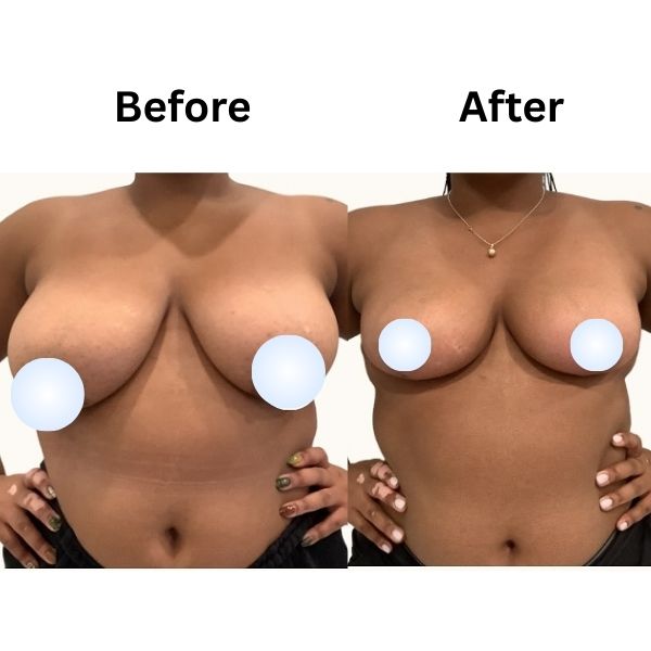 Breast Reduction Before after Result