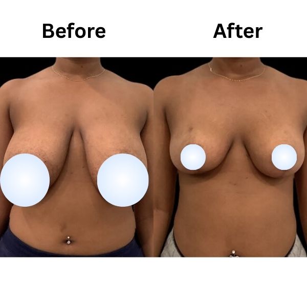 Breast reduction By Dr Vinay Jacob In Mumbai