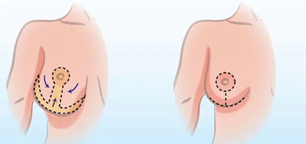 learn why consultation important before Breast reduction Surgery with Dr, Vinay Jacob