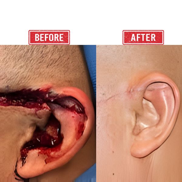 Ear Trauma Reconstruction in Mumbai