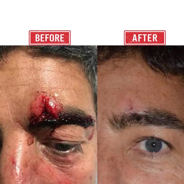 Eye Trauma Reconstruction Case 2 in Mumbai