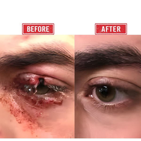 Eye Trauma Reconstruction in Mumbai