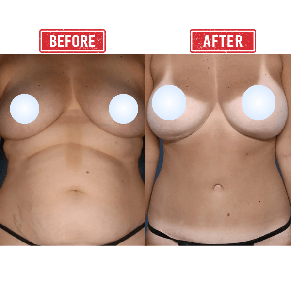 Mommy Makeover Breast Lift Before After