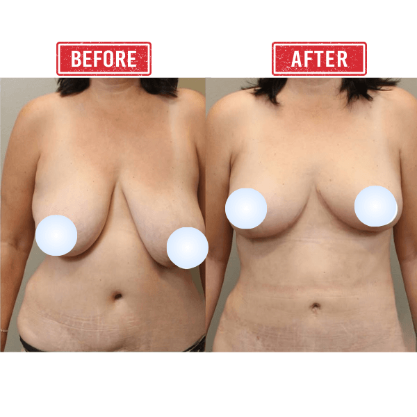 Mommy Makeover Breast Reduction