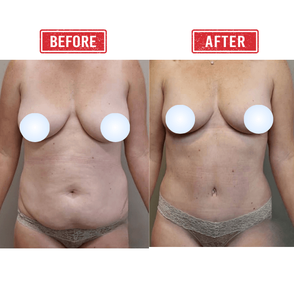 Mommy Makeover Breast Reduction