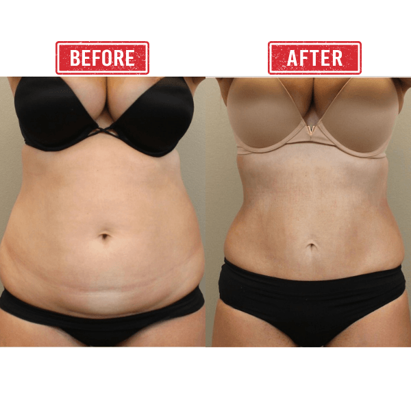 Mommy Makeover Tummy Tuck Before After