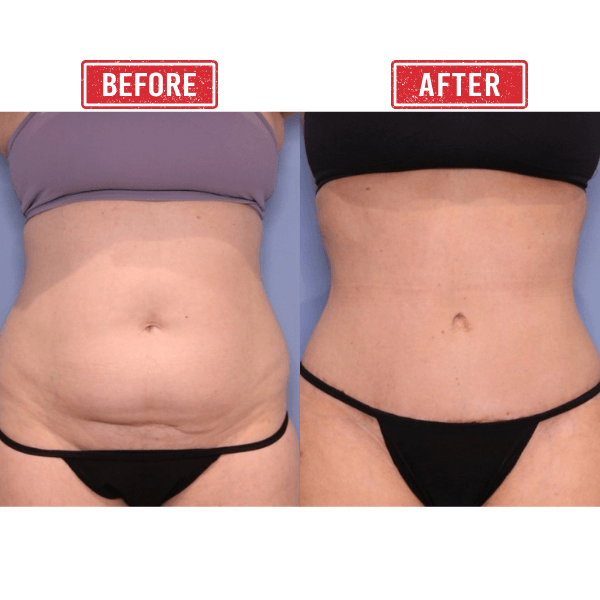Mommy Makeover Tummy Tuck Before After