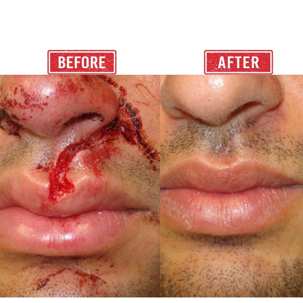 Nose Trauma Reconstruction in Mumbai