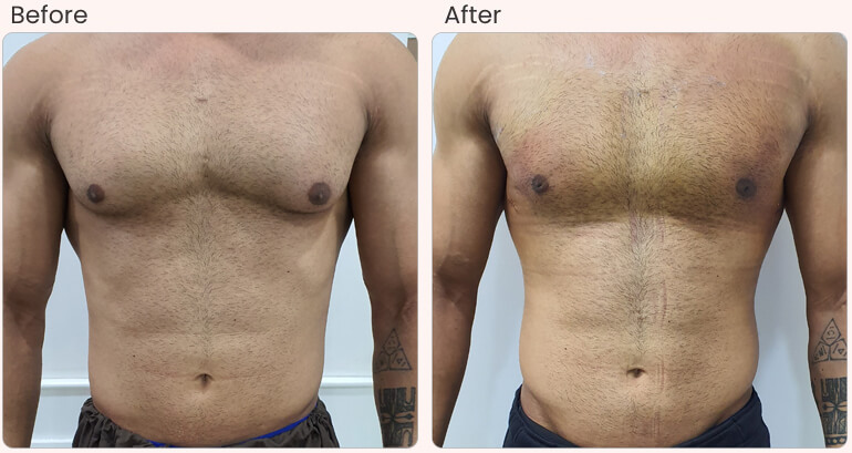 Gynecomastia Treatment in 2026