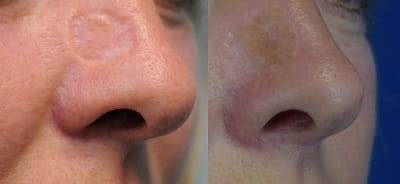 nasal reconstruction after cancer in Mumbai