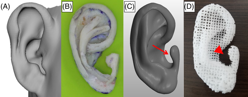 3D Printing and CAD-Assisted Design in Ear Surgery at Mumbai