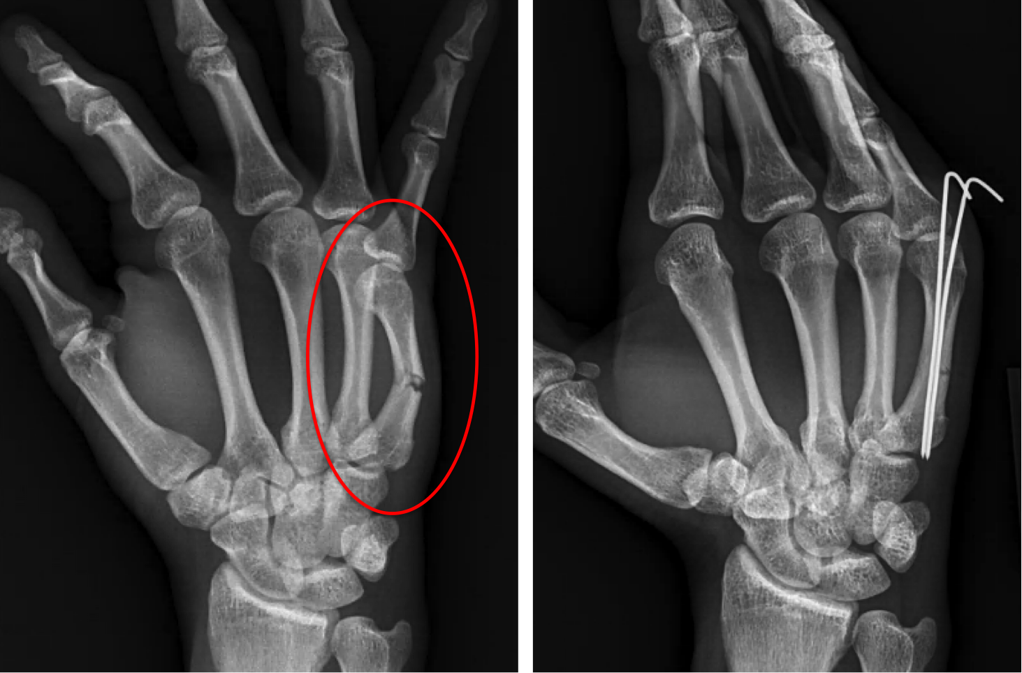 Fracture Repair
