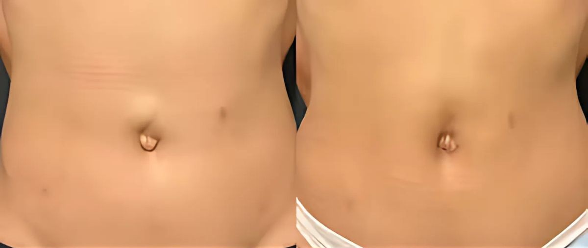 Abdominal Hernia Surgery in Mumbai