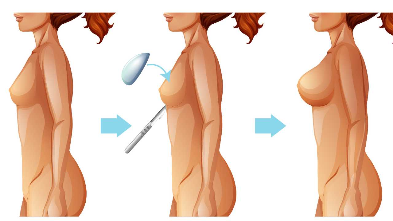 Breast Reconstruction