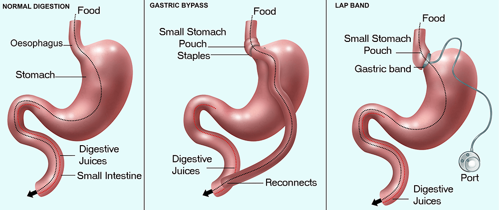 Bariatric Surgery in Mumbai by Dr. Vinay Jacob