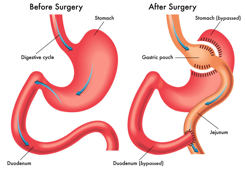 Benefits of Bariatric Surgery
