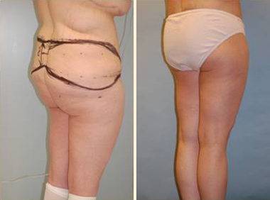 Learn Benefits of Lift Surgery In Mumbai with Dr. Vinay Jacob