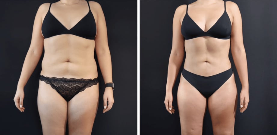 Learn about Body Lift Countouring Surgery By Dr Vinay Jacob