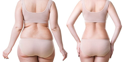 Body lift surgery in Mumbai with Dr Vinay Jacob