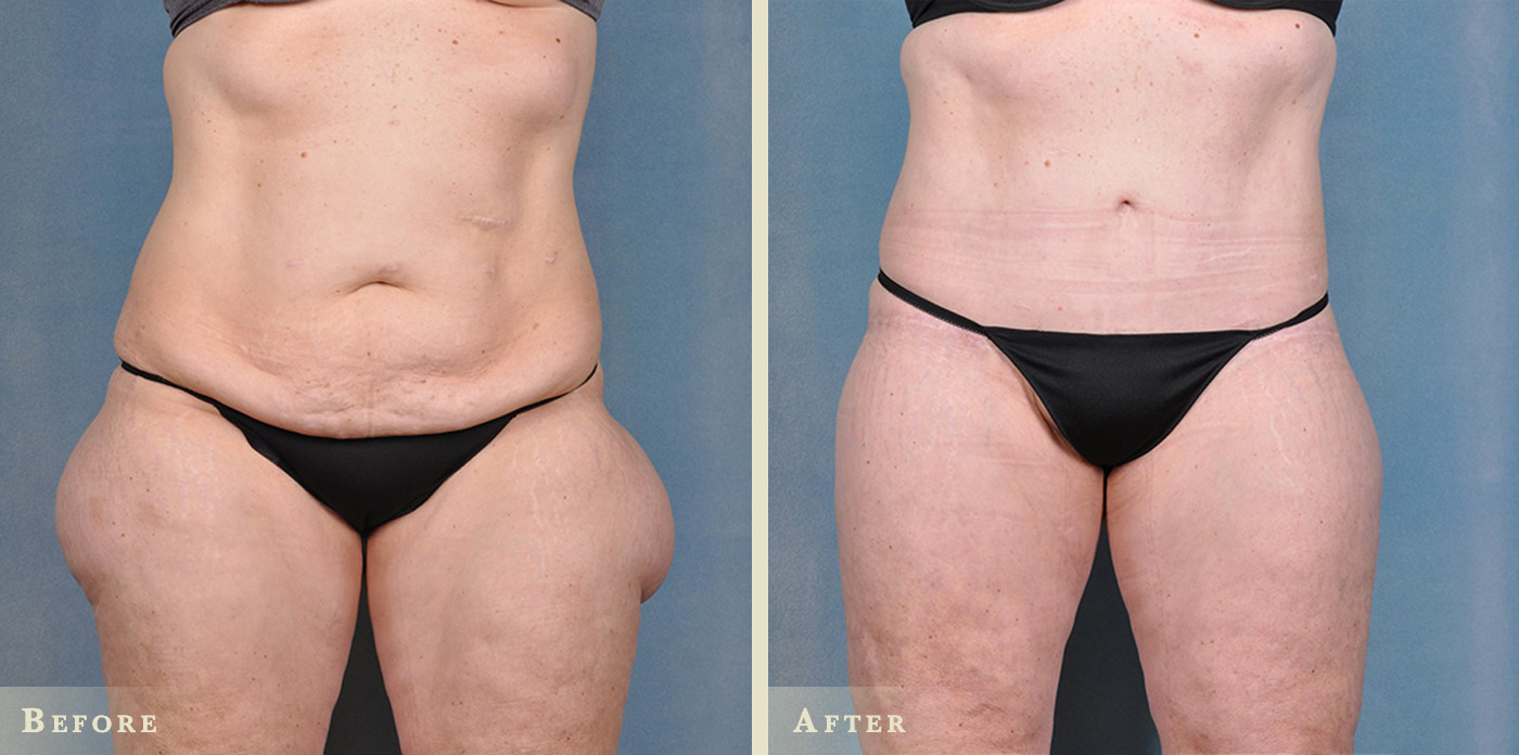 Body Lift Surgery in Mumbai with Dr Vinay Jacob