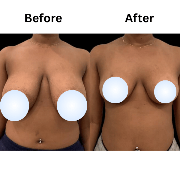 Breast Reduction Surgery in Mumbai by Dr. Vinay Jacob