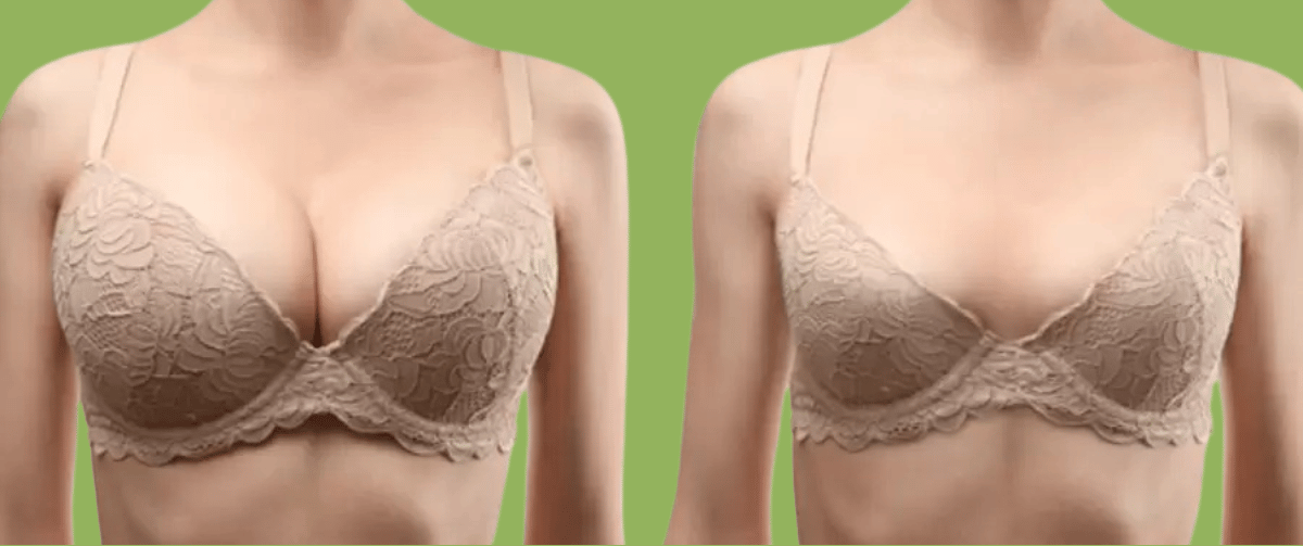 Breast Reduction Surgery