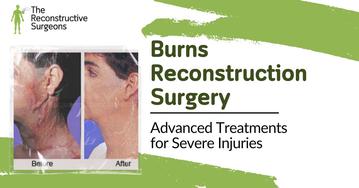Burn Reconstruction Mumbai Blog Image