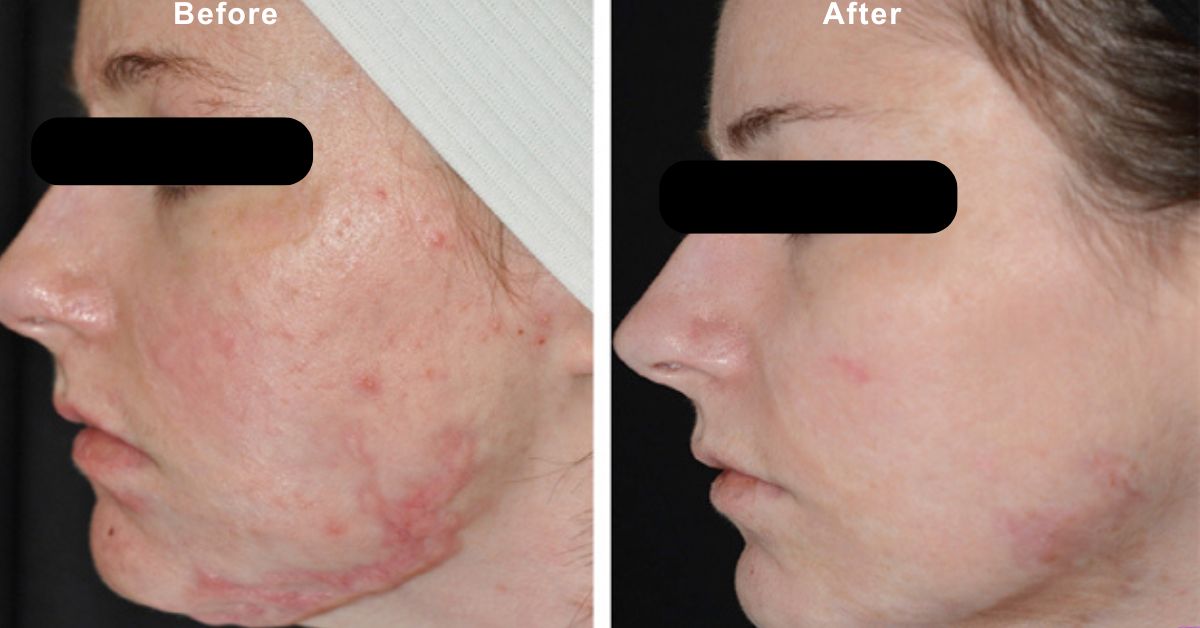 Learn about burn reconstruction with Dr. Vinay Jacob