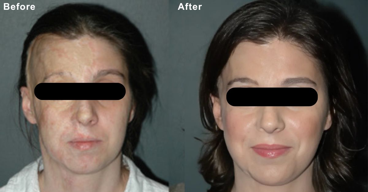 Burns Reconstruction Surgery in Mumbai by Dr. Vinay Jacob