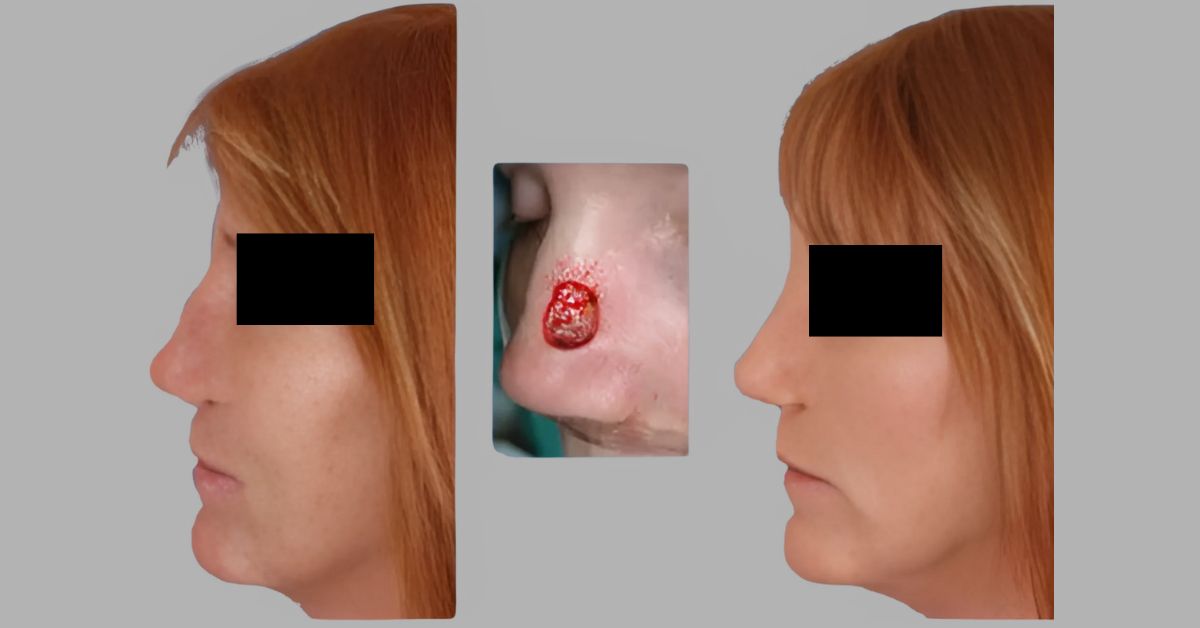 Guide to Cancer Reconstruction Procedures in Mumbai