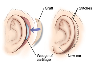 Cartilage Grafting for Ear Reconstruction in Mumbai