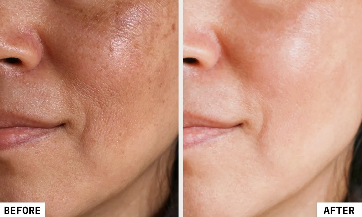 Chemical Peels for Skin Renewal in Mu,bai by Dr. Vinay Jacob