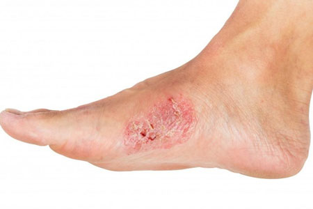 Chronic Wound Care in Mumbai by Dr. Vinay Jacob