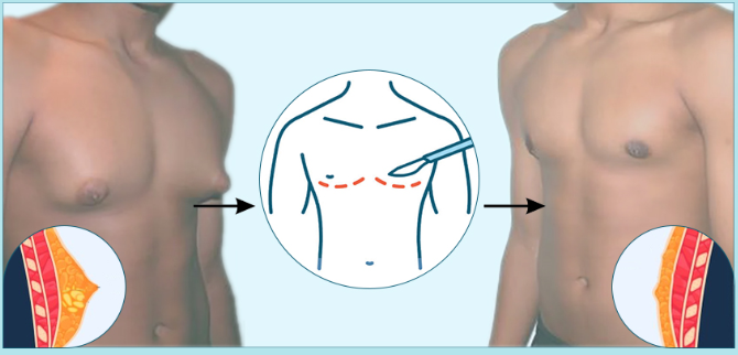 Cost of Gynecomastia Surgery in Mumbai