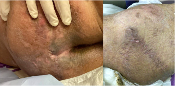 Debridement for Severe Bed Sores in Mumbai by Dr. Jacob