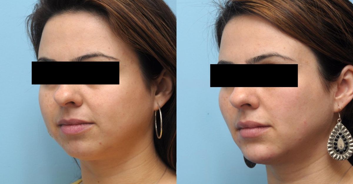 Dermal Fillers for Volume Loss in Mumbai by Dr Vinay Jacob