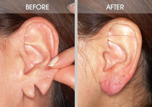 Ear Lobe Repair and Minor Deformity Correction in Mumbai