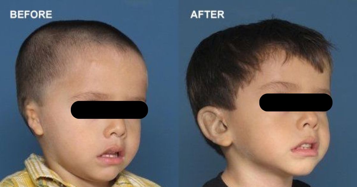 Ear Reconstruction innovative Techniques by Dr. Vinay Jacob