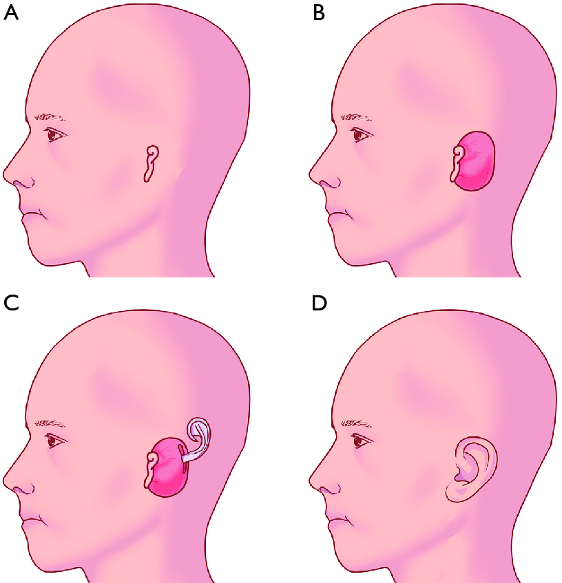 Expanded Skin Flap and Tissue Expansion for ear reconstruction in Mumbai