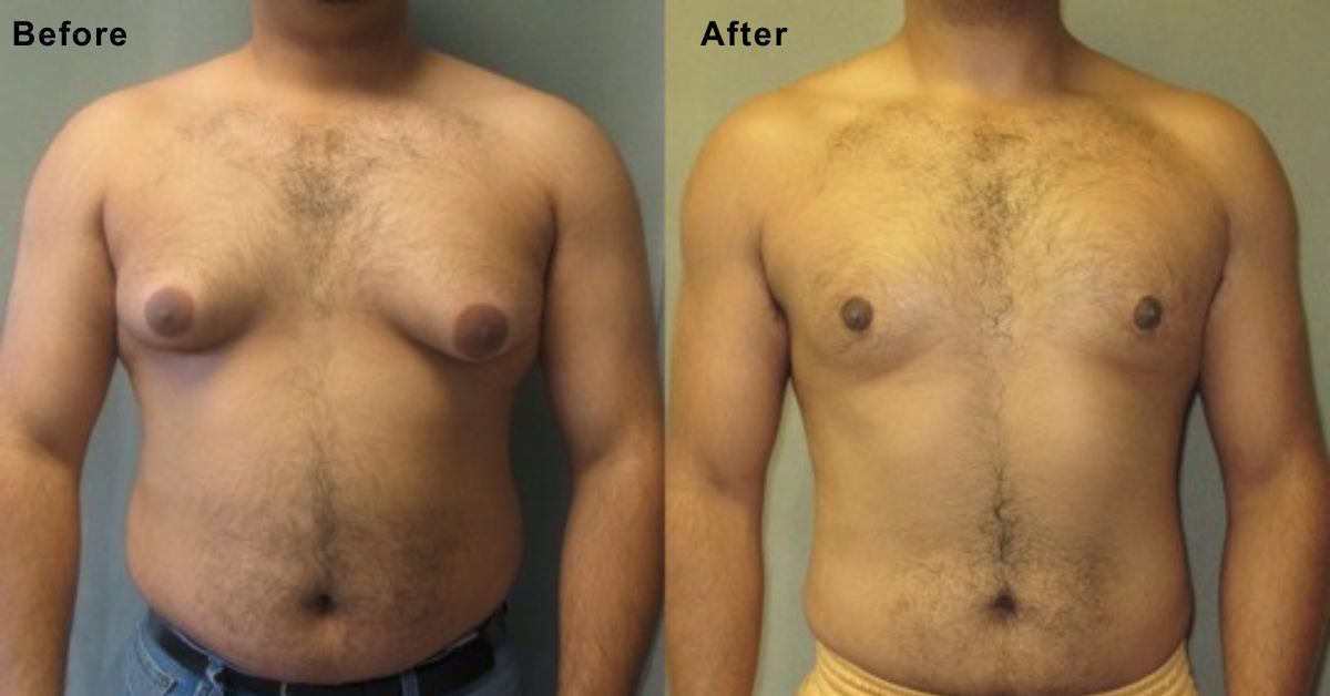 Exploring Male Breast Reduction Options in Mumbai