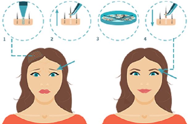 The Eyebrow Hair Transplant Procedure in Mumbai by Dr. Vinay Jacob