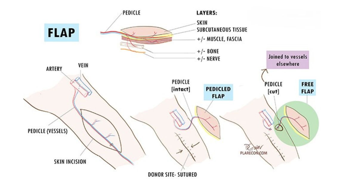 Flap surgery cost in Mumbai