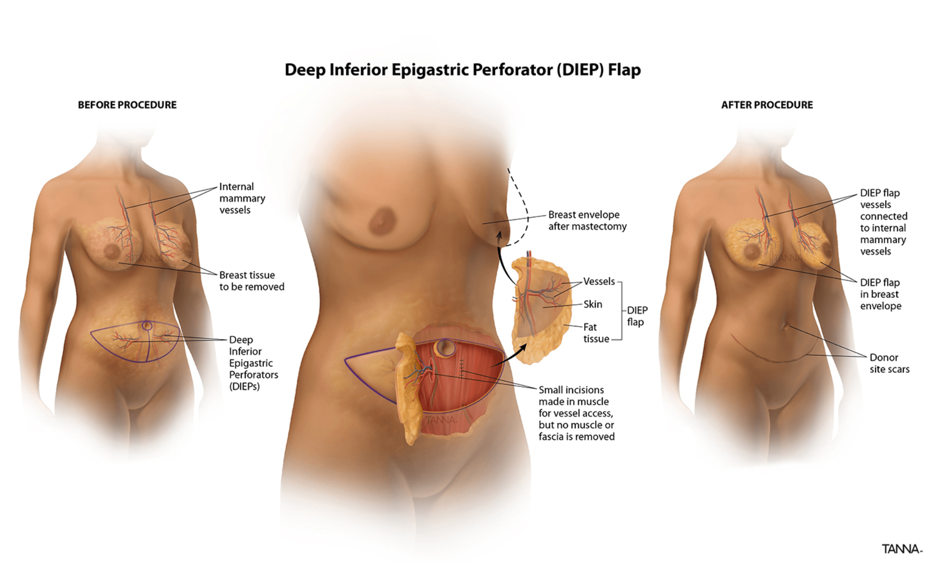Flap Surgery Cost in Mumbai