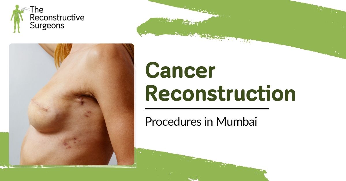 Guide to Cancer Reconstruction Procedures in Mumbai