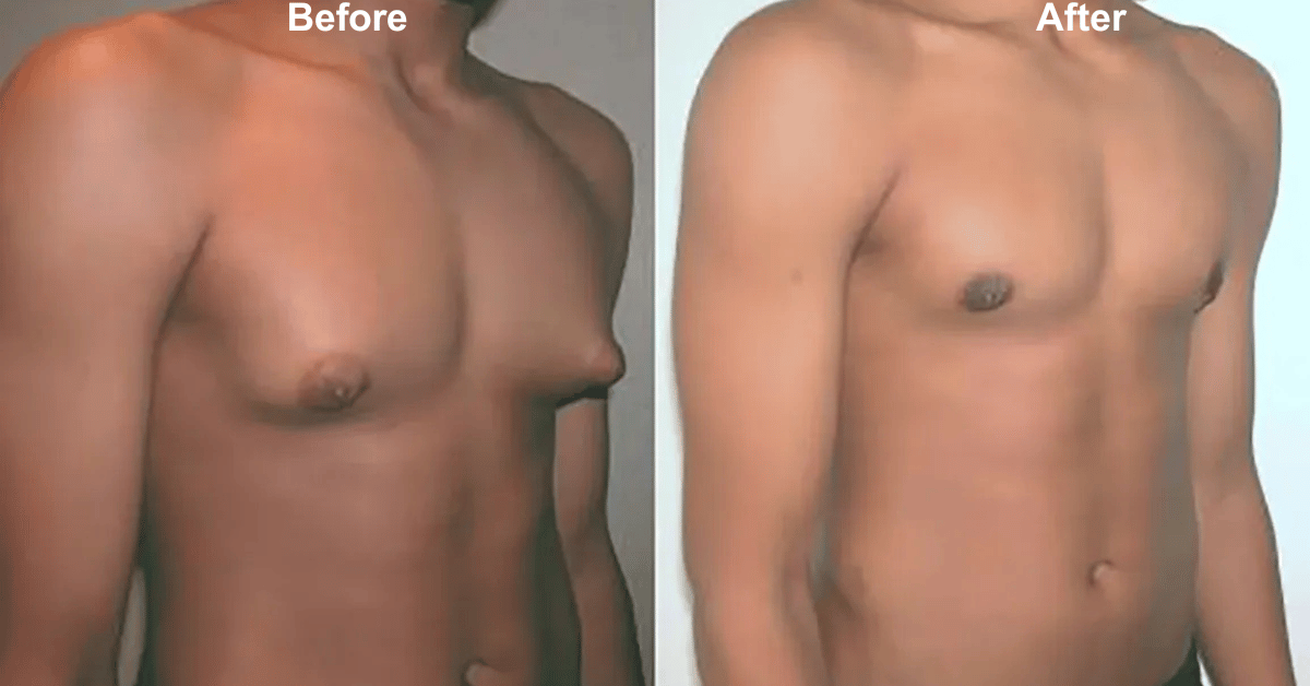 Gynecomastia surgery in Mumbai with dr Vinay Jacob